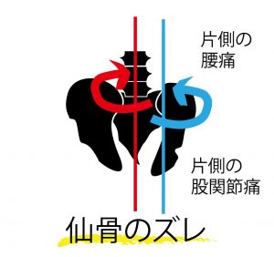 片側の腰痛,股関節痛,内腿が張る,歩くと腰がカクン