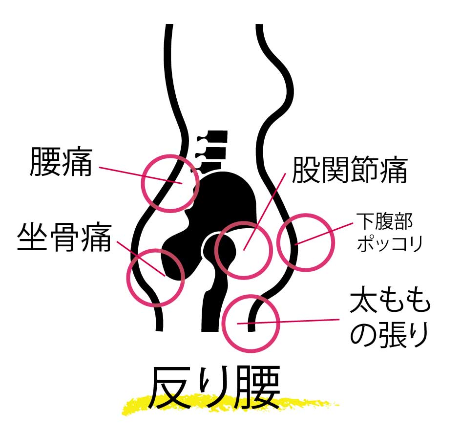 骨盤矯正,反り腰,腰痛,太腿の張り,ふくらはぎの張り