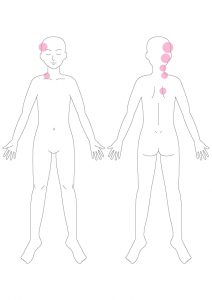 関連痛マップ 内臓が原因の身体の痛みの場所 大阪 梅田の整体 腸もみ 首痛や背中痛 腰痛 肩こり 胃もたれ 便秘 下痢 腹部膨満感 ガス 胃もたれにお悩みなら 整体サロントータルバランスover