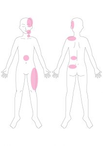 関連痛マップ 内臓が原因の身体の痛みの場所 大阪 梅田の整体 腸もみ 首痛や背中 痛 腰痛 肩こり 胃もたれ 便秘 下痢 腹部膨満感 ガス 胃もたれにお悩みなら 整体サロントータルバランスover