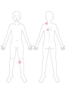 左肩の痛み,左肩痛,左の背中痛い,左背中痛,左膝の内側の痛み,左膝痛,膵臓