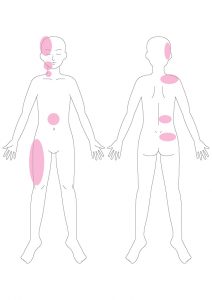 下 の 甲骨 背中 痛み 右側 肩 の 見過ごしやすい右側の背中のしびれには要注意！筋肉疲労との見分け方のポイントとは？｜ヘルモア