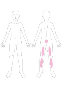 腰痛,太ももの裏の張り,ふくらはぎの痛み,踵の痛み,膀胱