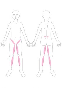 腰痛,ビキニラインの痛み,そけい部痛,太もも内側の痛み,腎臓