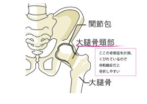 大腿骨頸部は骨折しやすい