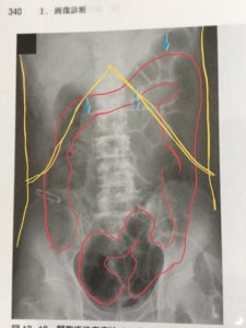 腹部膨満感