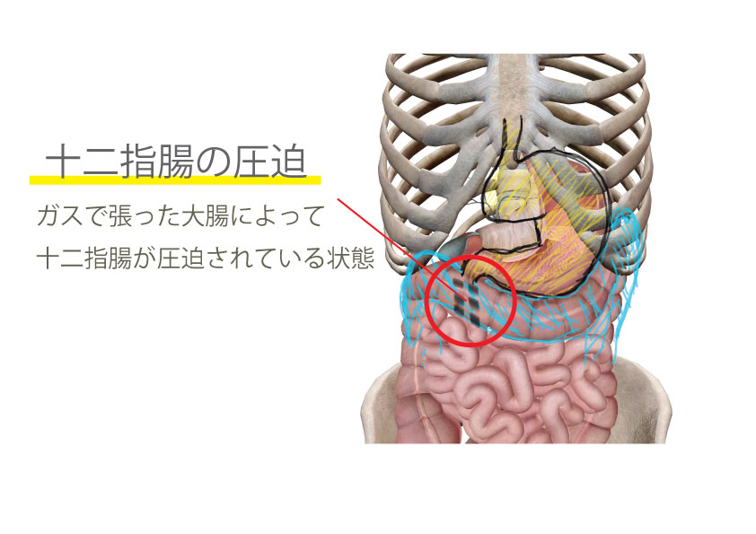 大腸がガスで張ったことによる十二指腸の圧迫