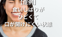 【症例】食いしばりがひどくて口が開けにくい状態